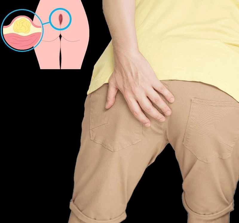 Latest technology used for anal abscess laser